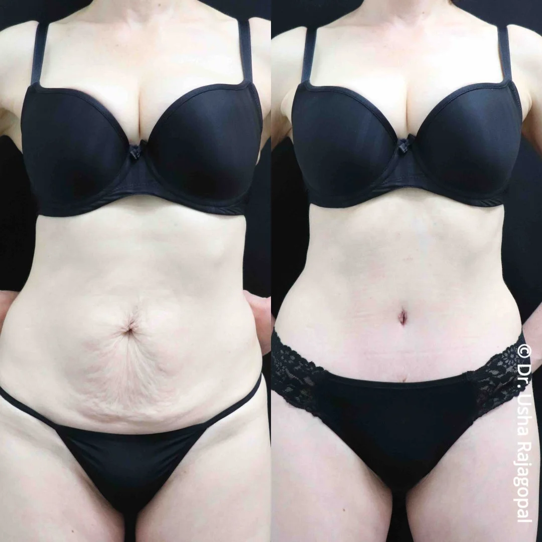Mommy Makeover transformation ✨

With abdominoplasty (tummy tuck), we tightened the abdominal area, removed loose, stretched skin, and refined her waistline for a smoother, firmer contour.

A tummy tuck can be a great option for women who have gone t