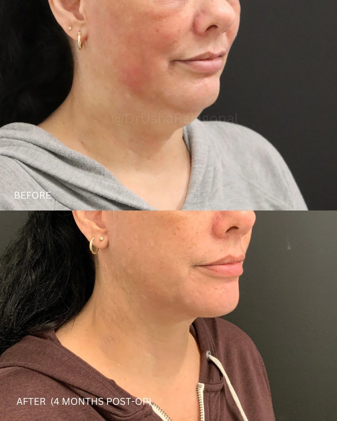 Check out the amazing results (4 months post-op) of a lower facelift and neck lift on our lovely patient!
