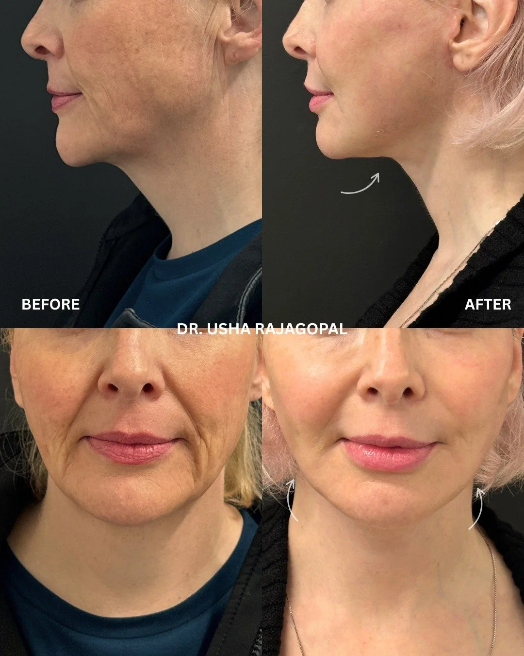 Six weeks post op. Lower facelift, neck lift, and targeted CO2 laser around the medial cheeks. Natural lift, sharper jawline, and smoother skin already, with refinements still to come. 

Interested in this procedure? Give us a call at 415-392-3333 to