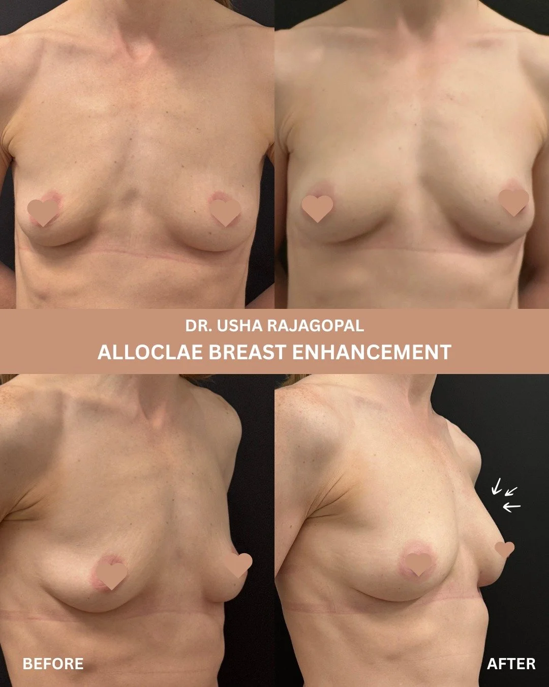 No-Implant Alloclae Breast Augmentation

Many women notice that after pregnancy and breastfeeding, their breasts can appear deflated or lose volume, even if their overall size has not changed dramatically.

For this patient, we used @alloclae to rest