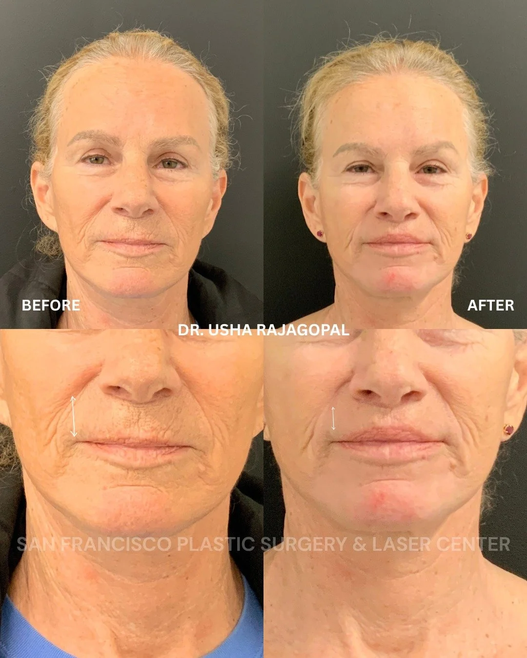 This beautiful patient had a prior lip lift elsewhere and wanted a more dramatic improvement. Her lip height was reduced from 18mm to 14mm, creating a shorter, more refined upper lip and better overall balance.

These cases require careful planning, 