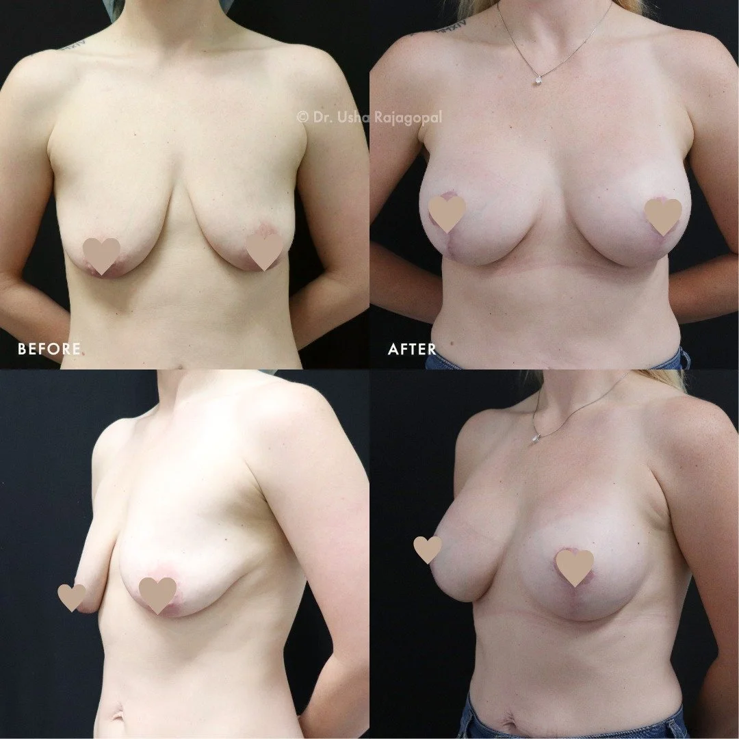 Beautiful breast lift + augmentation with implants 👙 Natural-looking fullness, volume, and enhanced shape! #BreastsByDrUsha #MommyMakeover