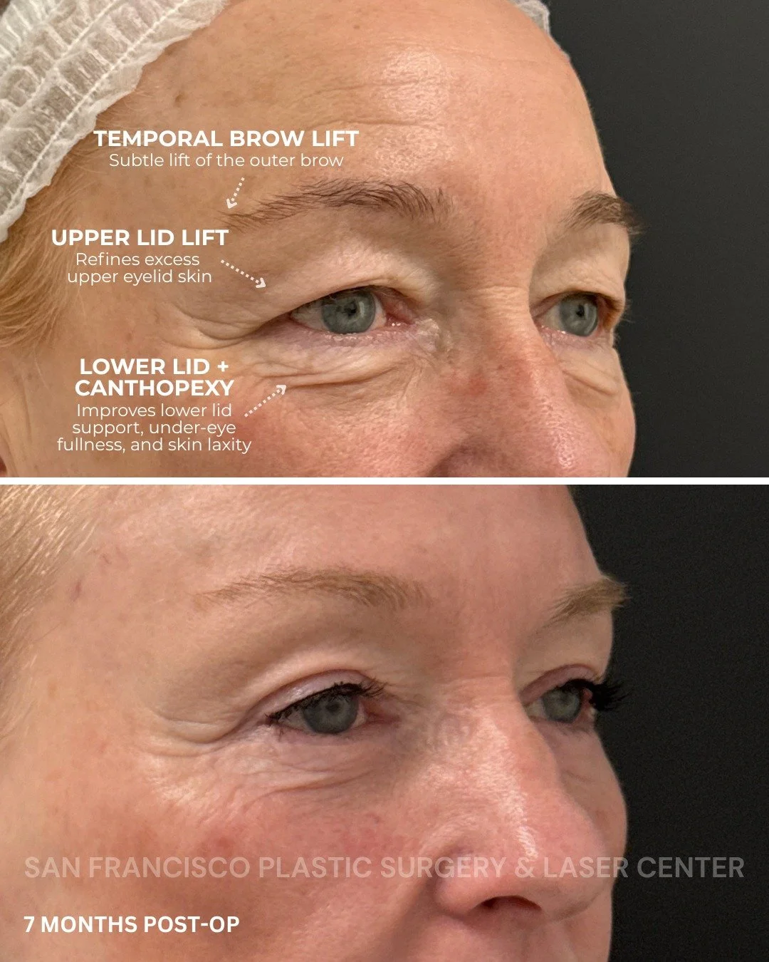A refreshed, brighter eye area with a natural result that still looks like her.

For this beautiful patient, we performed a customized eye rejuvenation plan that included:

&bull; Temporal brow lift to create a subtle lift of the outer brow
&bull; Up