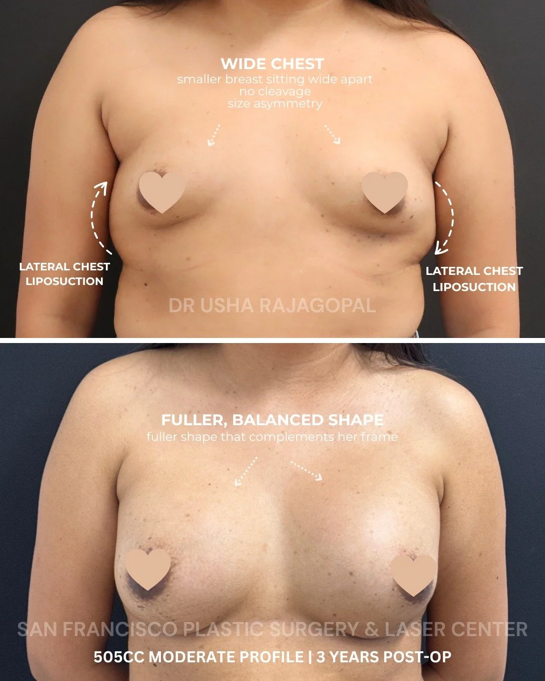 This patient had a naturally wider chest and smaller breasts that sat farther apart on her frame. The patient received 505 cc moderate-profile implants placed above the muscle, along with liposuction of the lateral chest to help create a softer, more