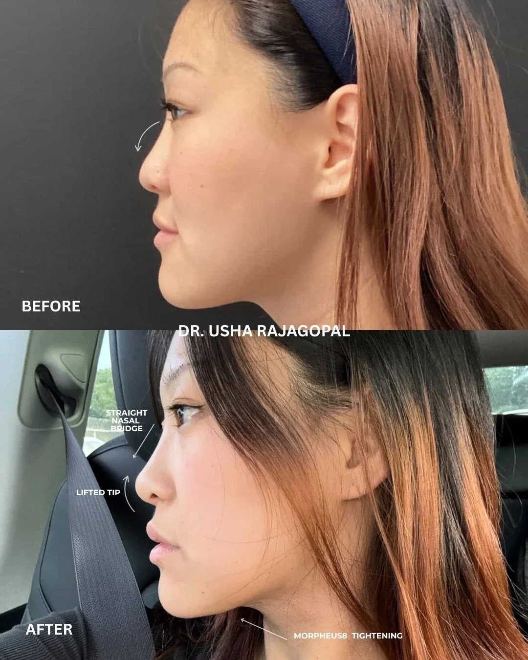 A more sculpted, balanced nose without surgery? It is possible with nose filler.

Our non-surgical nose enhancement takes just 15 minutes, involves no downtime, and offers immediate results.

💉 What can be achieved with filler:

✔️ Camouflage a nasa