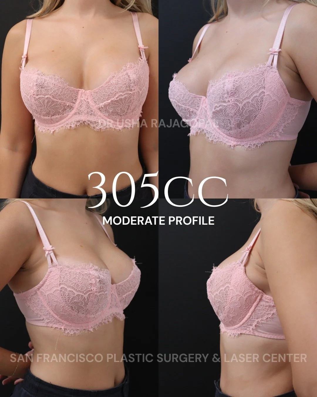 Beautifully natural breast augmentation results using 305cc moderate profile implants.

This result is soft, balanced, and proportionate to her frame.

Send us a DM to learn more about pricing, candidacy, and what to expect during the breast augmenta
