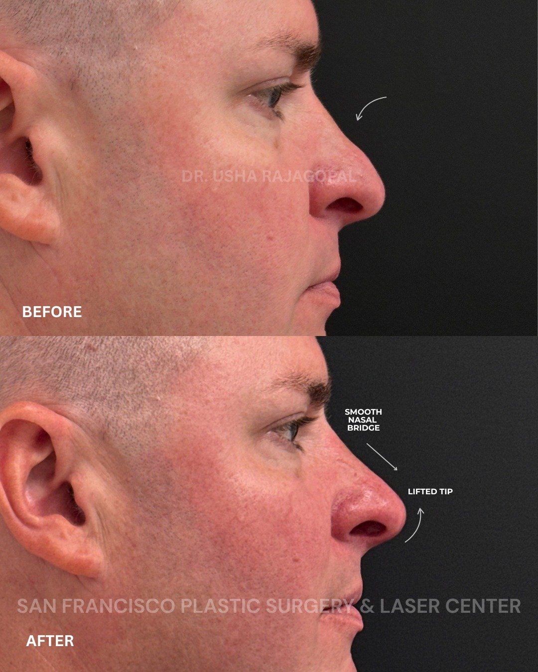 Nose filler can be a great option for balancing the profile without surgery.

For this patient, we used filler to create a smoother nasal bridge and a subtle lift to the tip, giving the nose a more refined and balanced appearance from the side.

We i