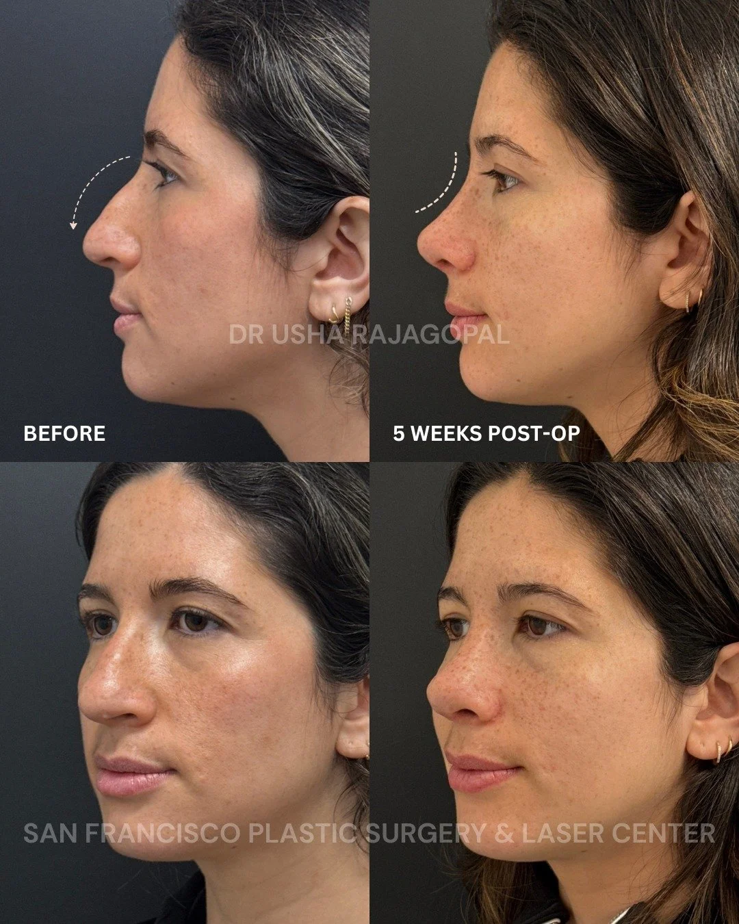 Only 5 weeks post-op from rhinoplasty and already looking so beautiful!

At this early stage, she is still healing and swelling is completely expected, but we are already seeing such a nice improvement in her profile and overall facial balance.

Her 