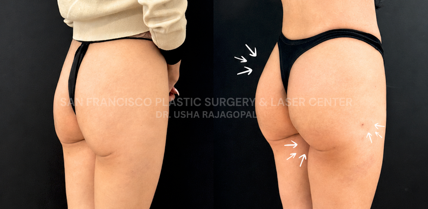 Non-Surgical Butt Lift and Hip Dip Enhancement in San Francisco with Alloclae