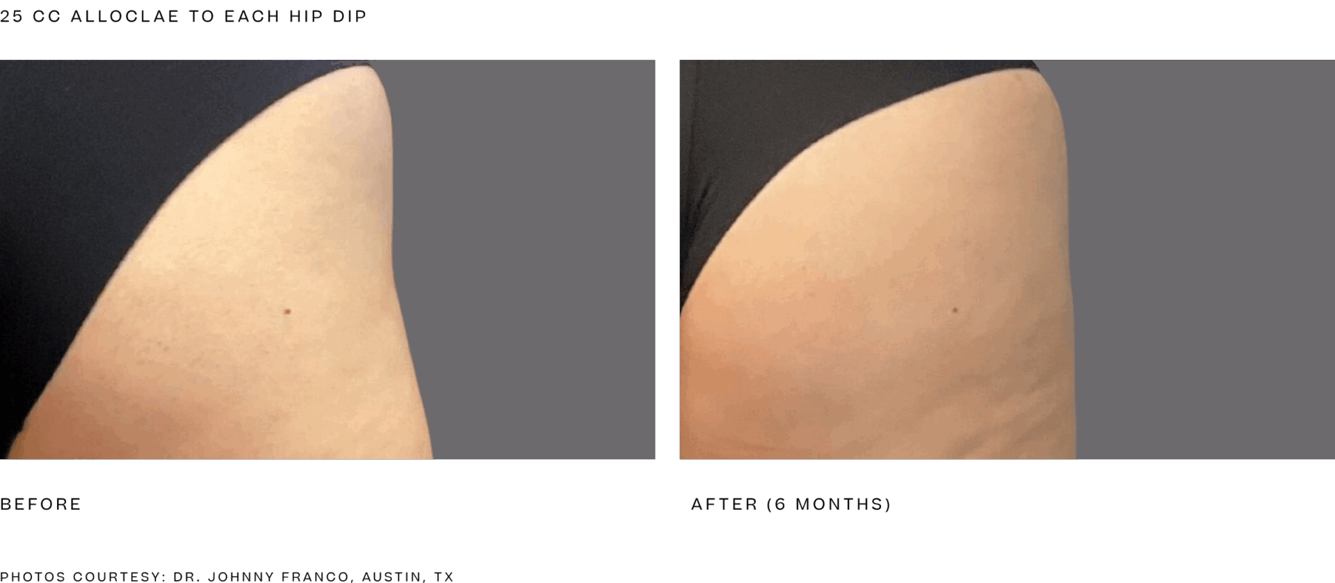 alloclae bbl (25cc per hip dip).png