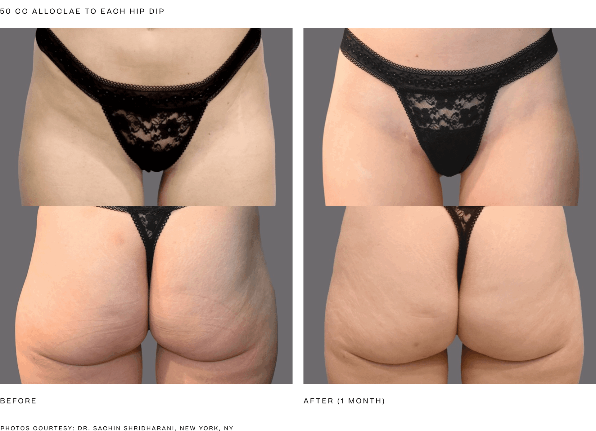 alloclae bbl (50cc per hip dip) 1 month.png