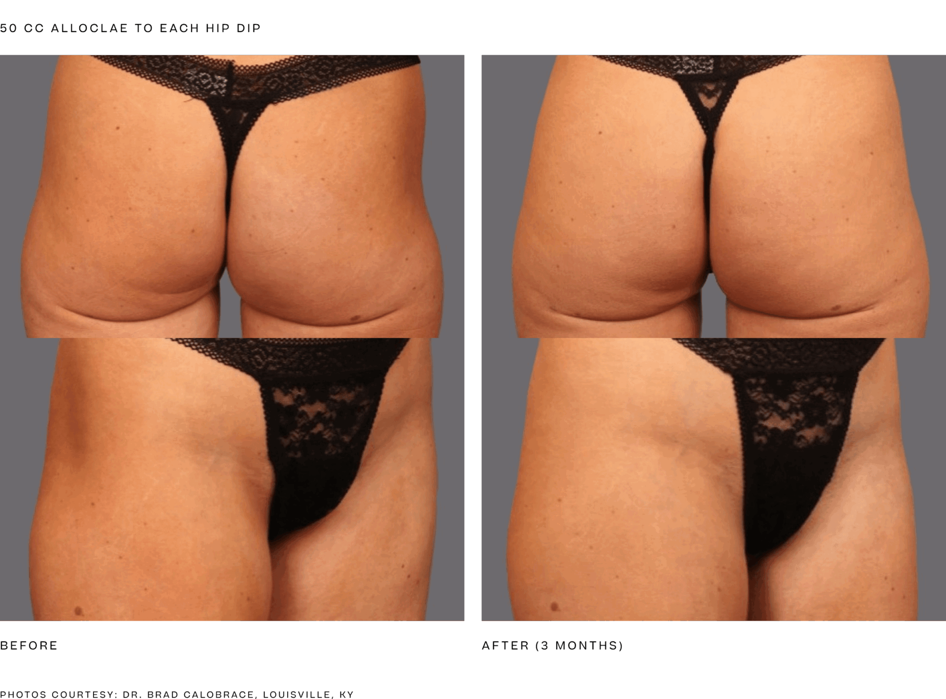 alloclae bbl (50cc per hip dip) 3 months.png