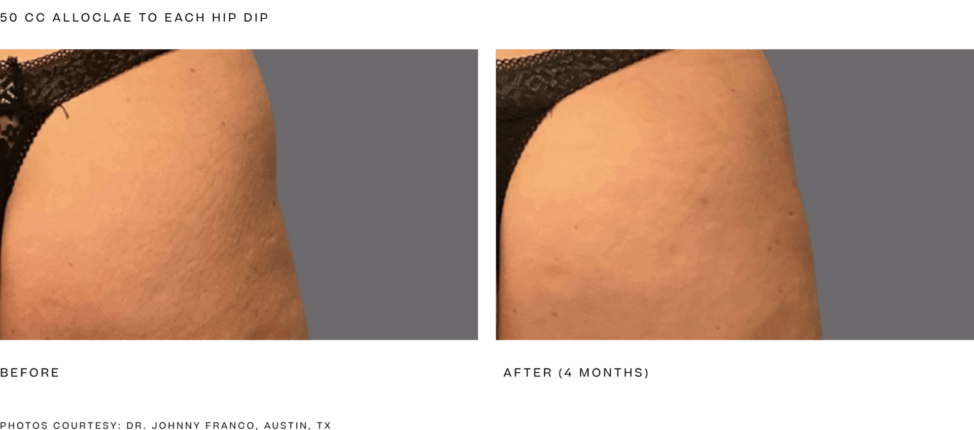 alloclae bbl (50cc per hip dip) 4 month.png