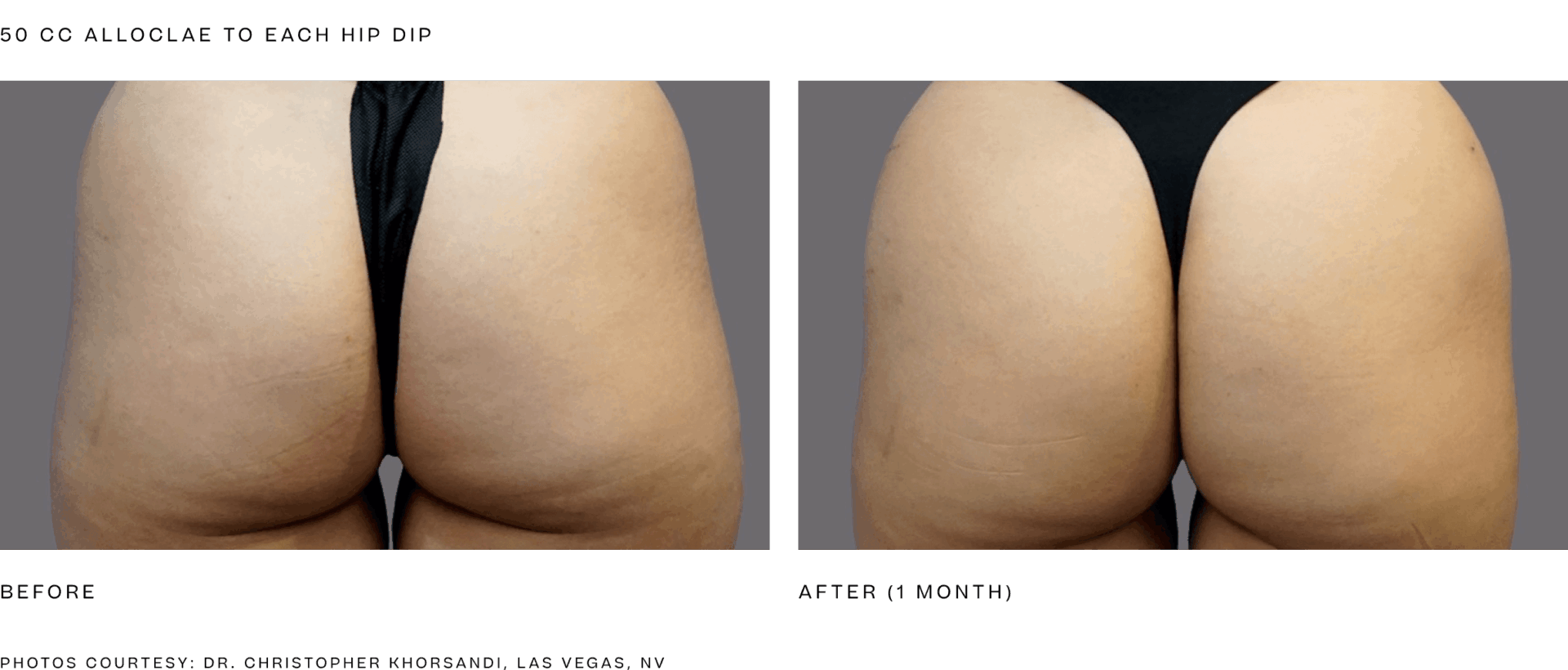 alloclae bbl (50cc per hip dip).png