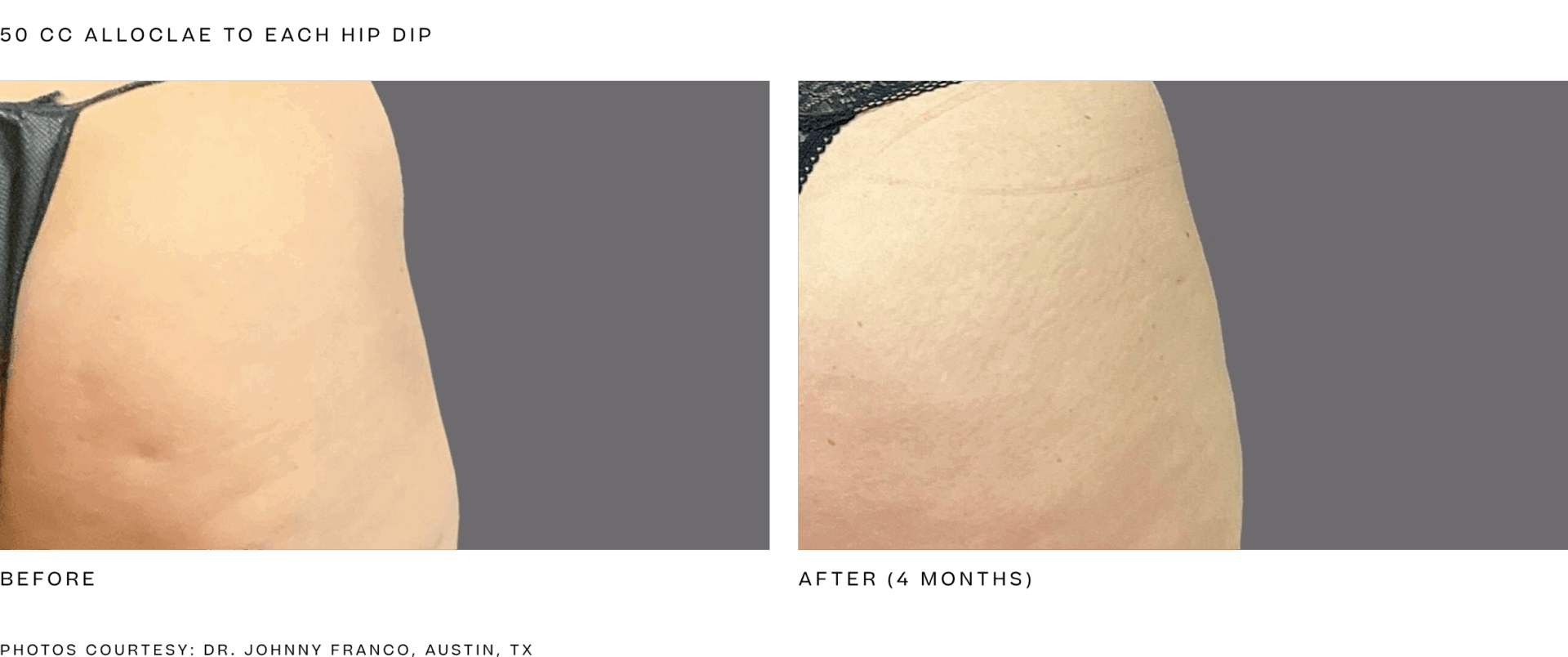 alloclae hip dip (50cc per hip).png