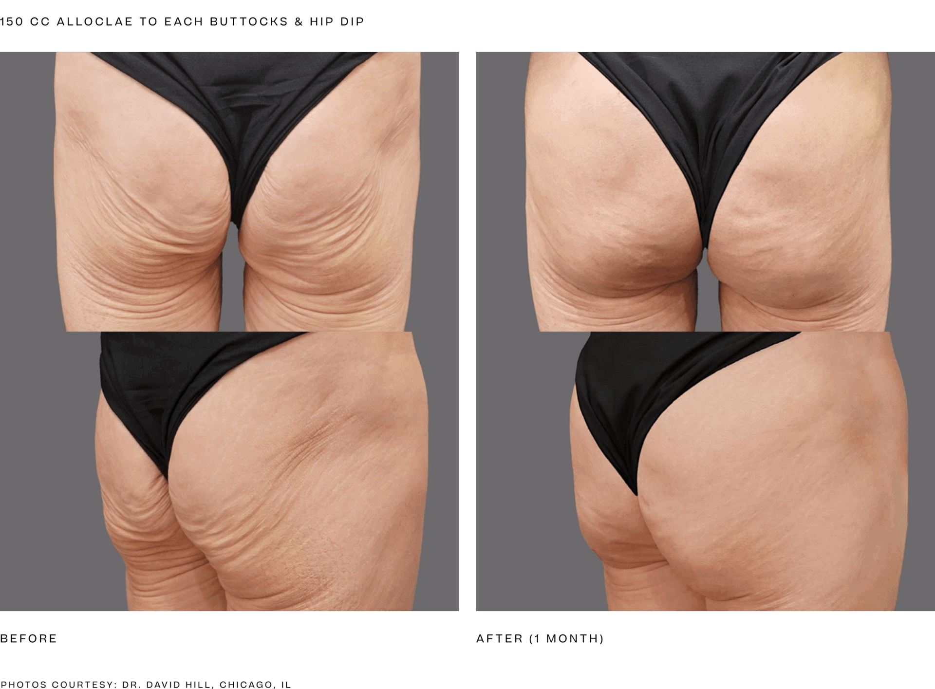 alloclae bbl (150cc per butt and hip).png