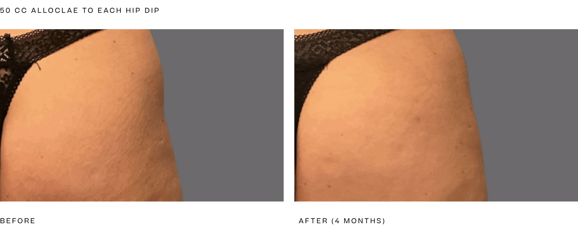 alloclae+bbl+%2850cc+per+hip+dip%29+4+month.png
