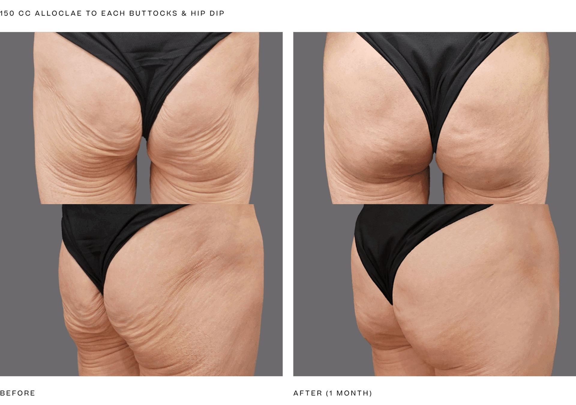 alloclae+bbl+%28150cc+per+butt+and+hip%29.png