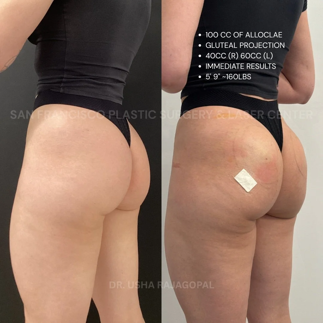 Want more gluteal projection without surgery? ☀️ Comment &ldquo;ALLOCLAE PRICING&rdquo; or send us a DM for special pricing and treatment information.

This patient already had a beautiful, natural shape but wanted more projection and improved balanc