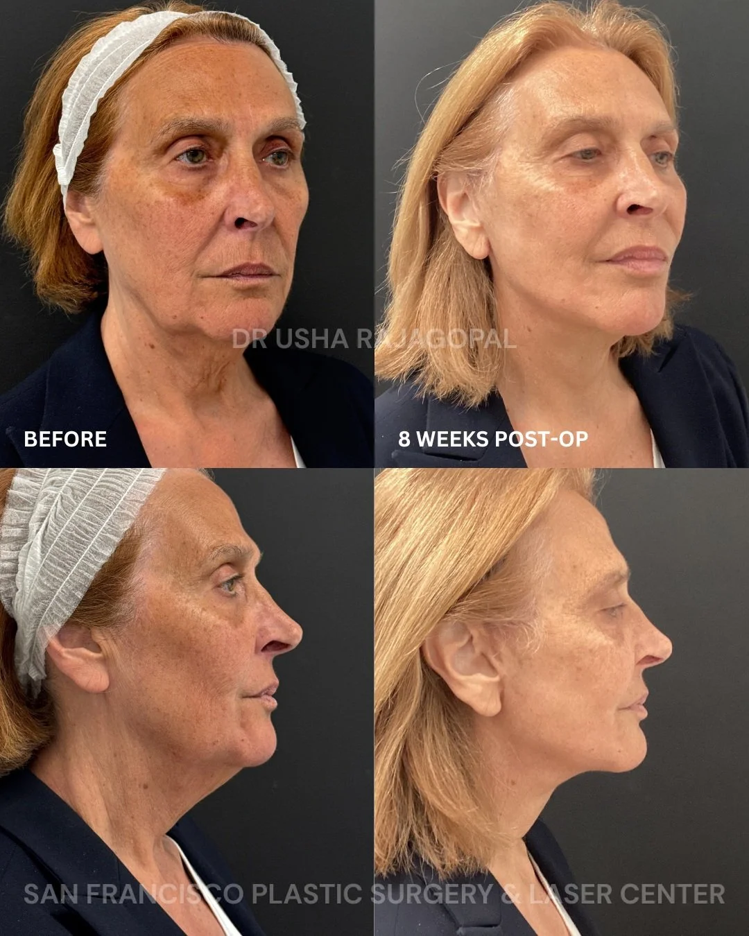 Facelift + Neck Lift + Fat Transfer = A beautiful, natural-looking transformation ✨

Stay tuned for my next video, where I will take you through this patient&rsquo;s case and explain how we achieved her refreshed results.