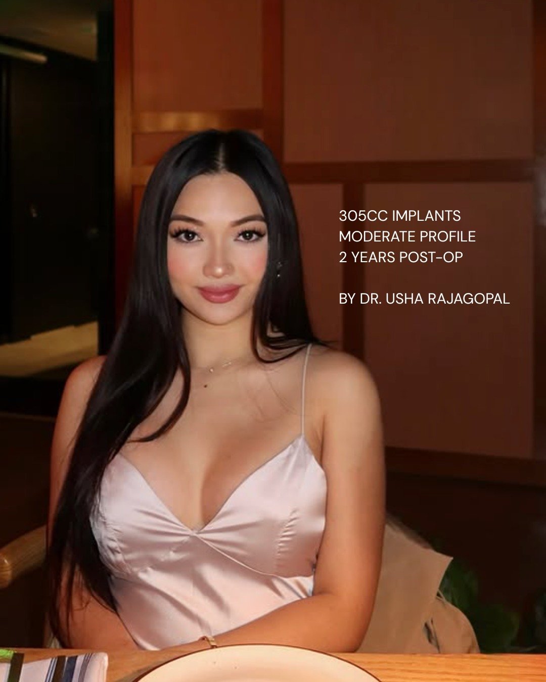 2 years post-op! 🔥 305cc moderate profile breast implants // petite frame

#BreastsByDrUsha

💸 Financing for Breast Augmentation

Planning on getting a breast augmentation? Right now is the best time to get it done! We are offering amazing financin