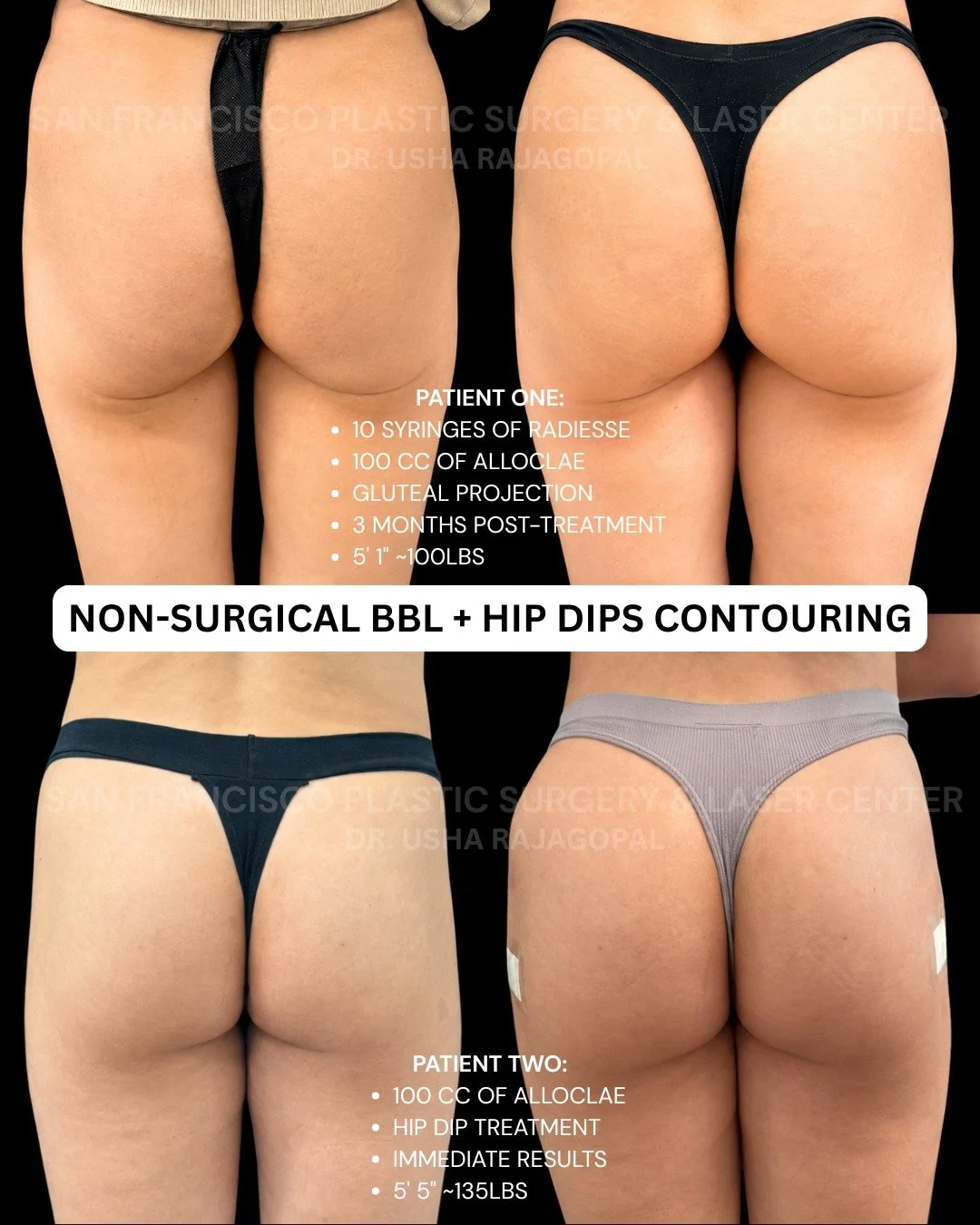 These two patient examples show how 100cc of Alloclae may be used differently depending on a patient&rsquo;s anatomy, body type, and treatment goals. 🍑💉

Top patient:
This petite patient is 5'1&rdquo; and approximately 100 pounds. She first receive