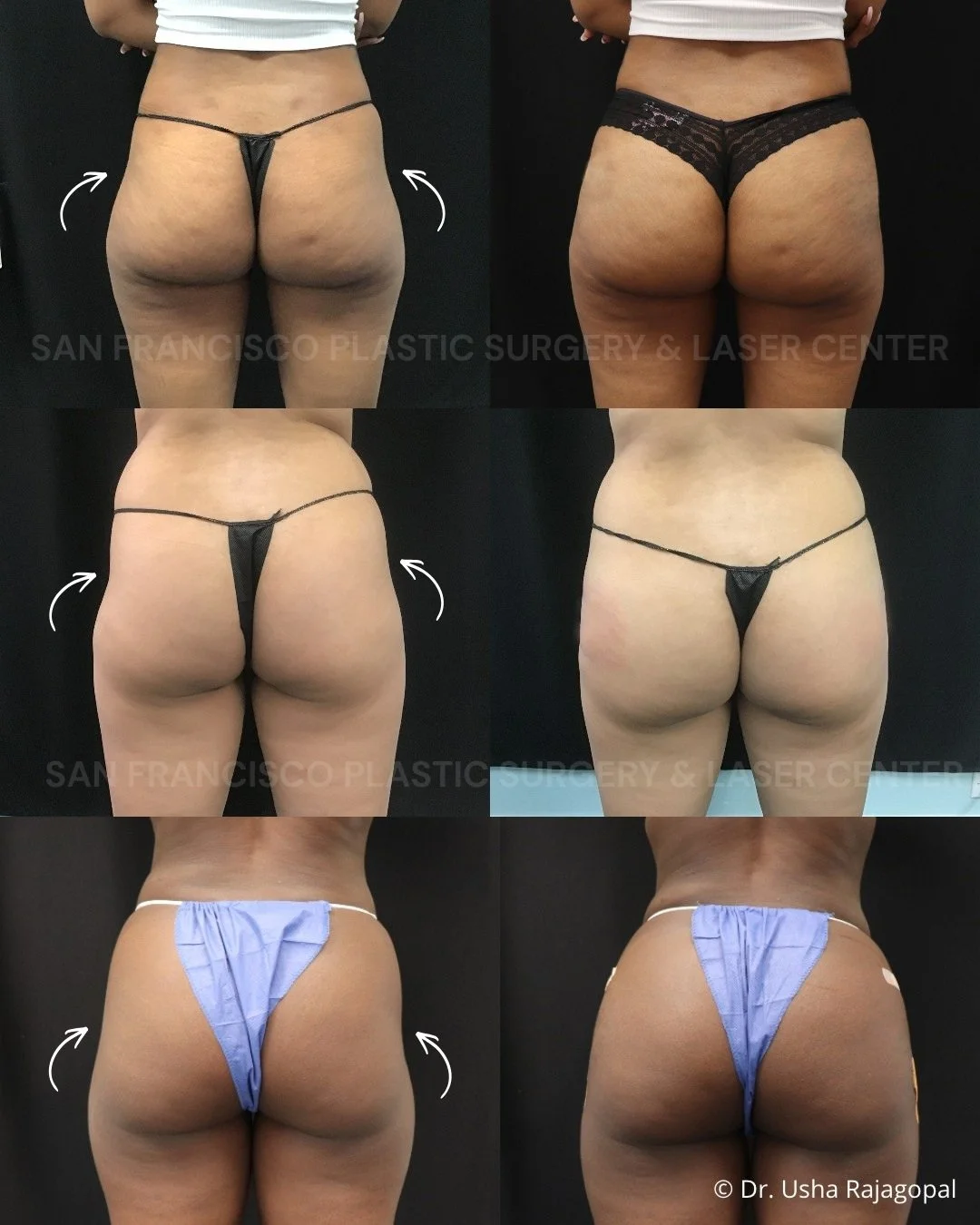 Hip dips? We have options. 🍑

We offer several non-surgical options to soften hip dips, improve symmetry, enhance projection, and create a smoother transition from the waist into the buttocks.

Every patient has different anatomy and goals, so we cu