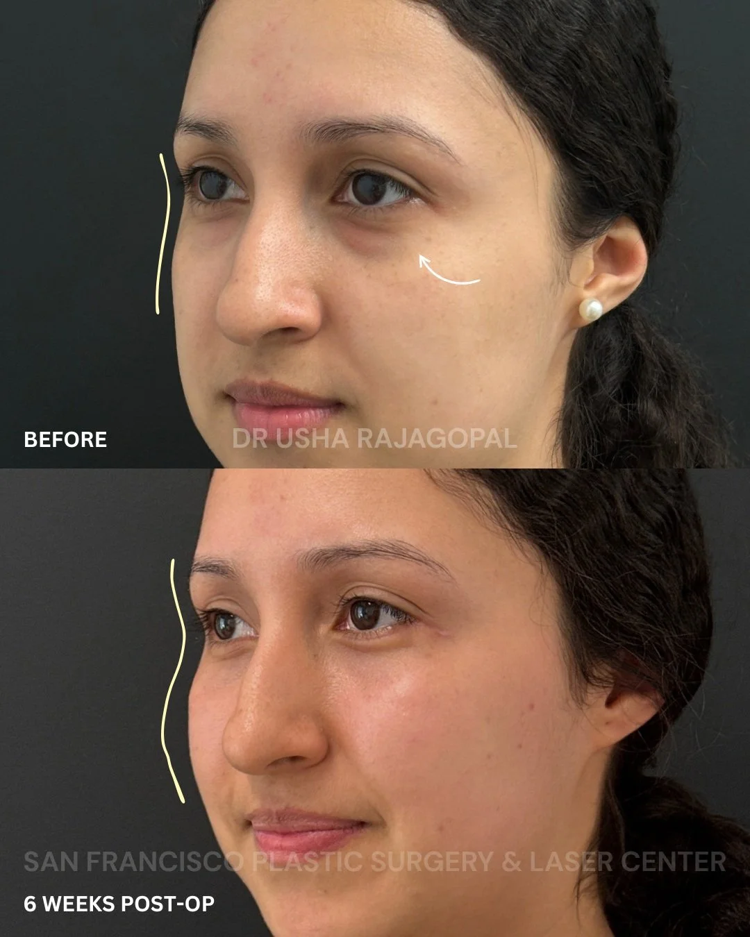 We are excited to share this beautiful patient&rsquo;s 6-week results after lower eyelid surgery + fat transfer ✨

Our patient is in her early 20s and came to us because she was bothered by her under-eye bags. She also had a flatter midface, which ma