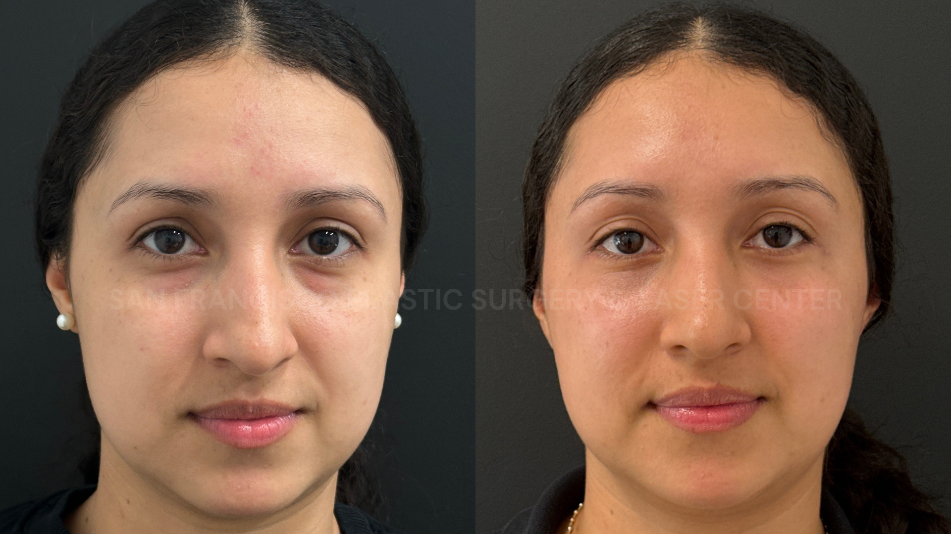 Lower Blepharoplasty With Fat Transfer for Prominent Under-Eye Bags in a Young Patient