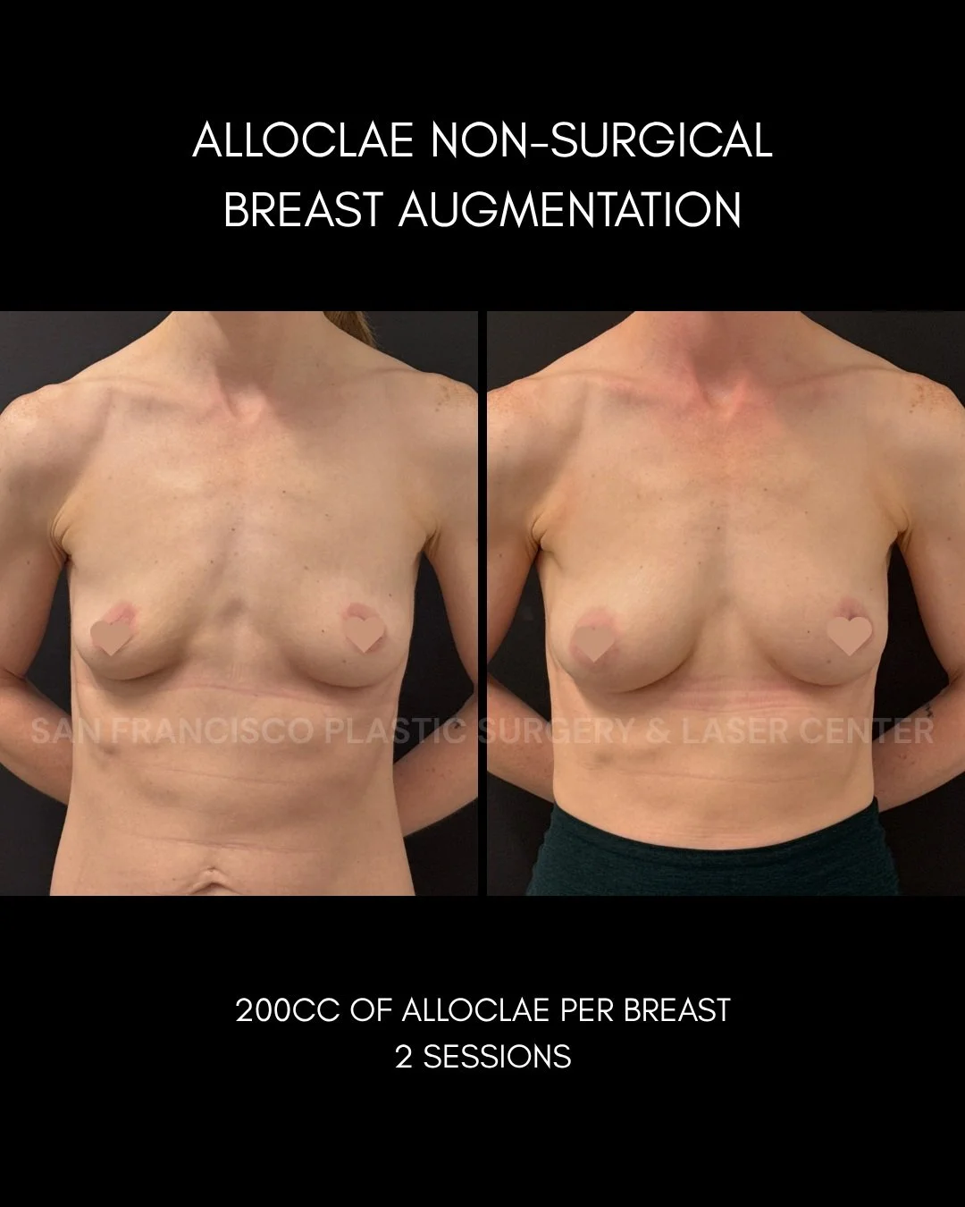 We are excited to share an updated result from this patient after her 2nd round of #Alloclae non-surgical breast enhancement!

After pregnancy and breastfeeding, she noticed a loss of volume that left her breasts looking more deflated. She wanted to 
