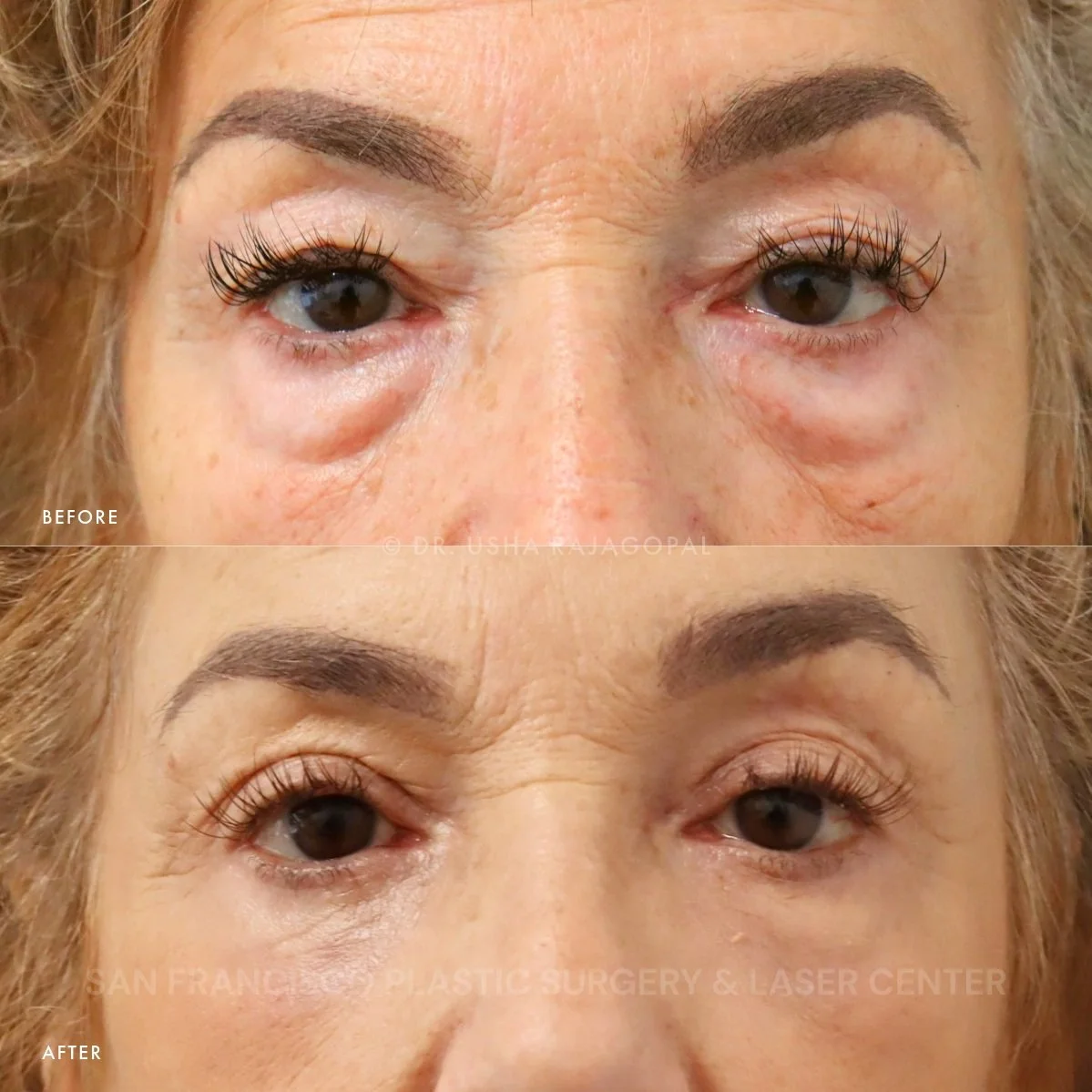 Our lovely patient had an upper + lower blepharoplasty, CO2 laser around the eyes, and fat transfer to the under-eye area. She looks so much more rejuvenated and rested. 👀✨

Interested in under-eye rejuvenation (surgical or non-surgical)? Send us a 