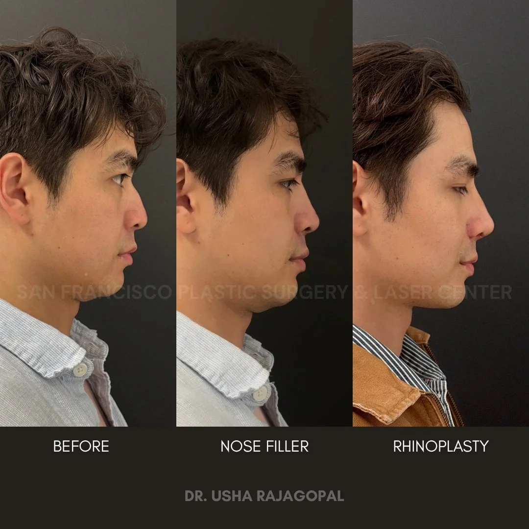 This handsome patient came to us wanting to reshape and contour his nose, with a particular focus on building a stronger, more defined bridge.

He first started with nose filler, which can be a great option for appropriate candidates who want to expl
