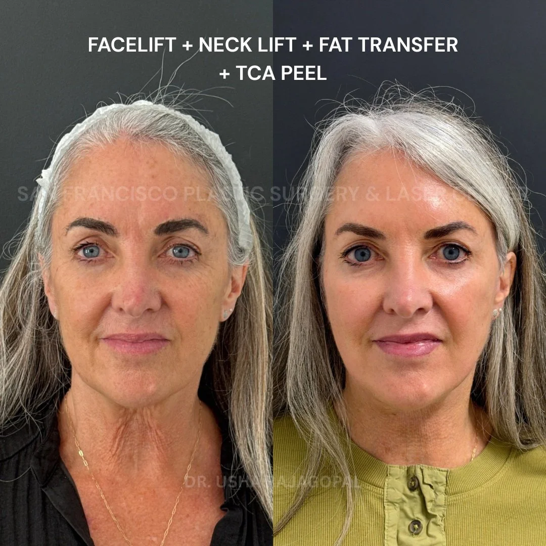 This beautiful patient in her early 60s was an excellent candidate for a comprehensive approach to facial rejuvenation. 

She underwent a facelift, neck lift, facial fat transfer, and TCA peel, allowing us to address several aspects of facial aging t