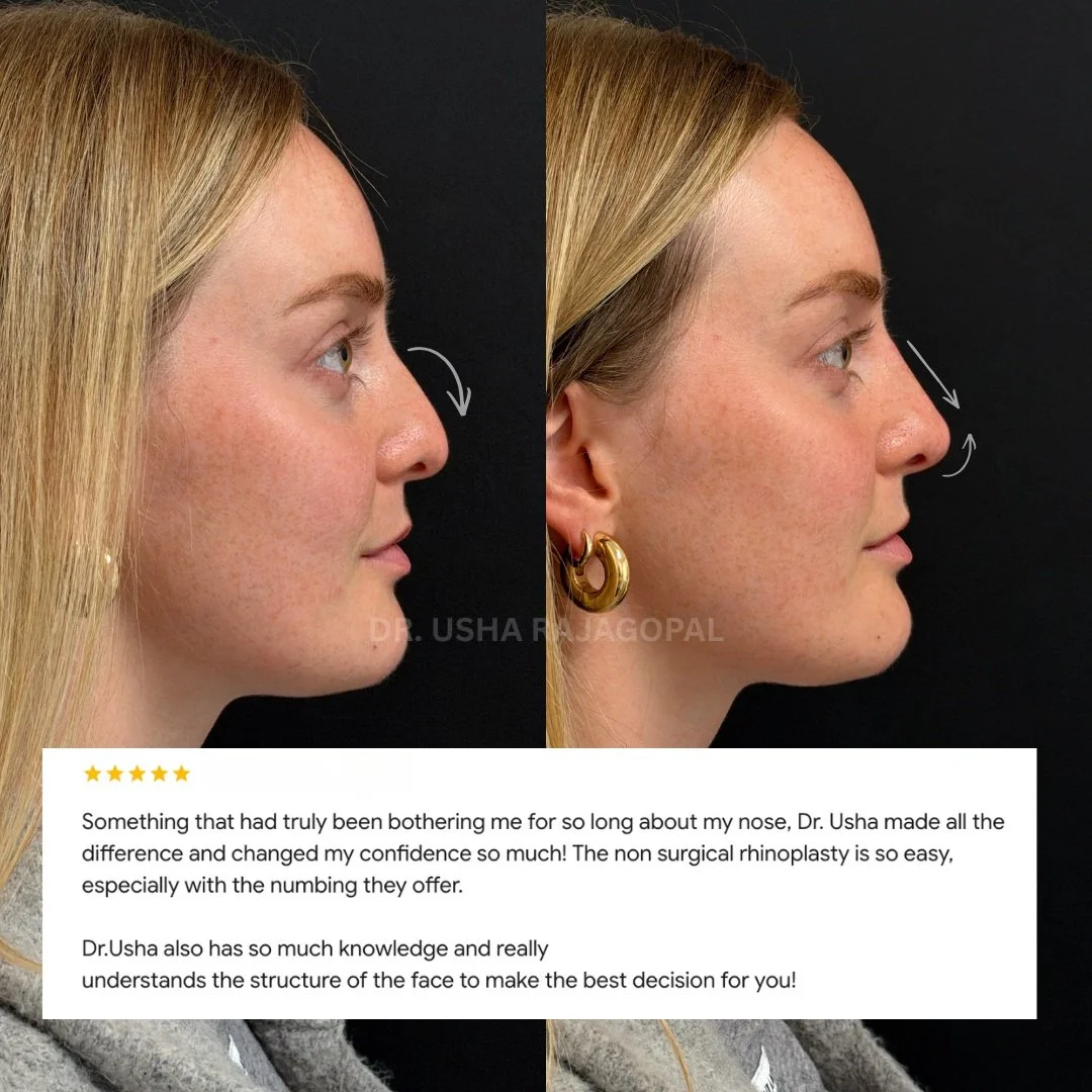 A little refinement can make such a difference! We love how this non-surgical rhinoplasty result turned out! We used dermal filler to smooth the bridge, subtly lift the nasal tip, and create a more balanced profile while keeping everything looking na