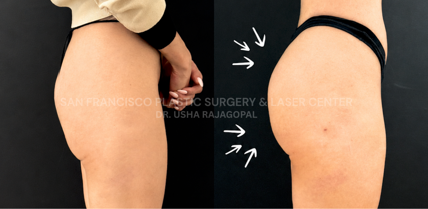 Alloclae Butt Lift_side view.png