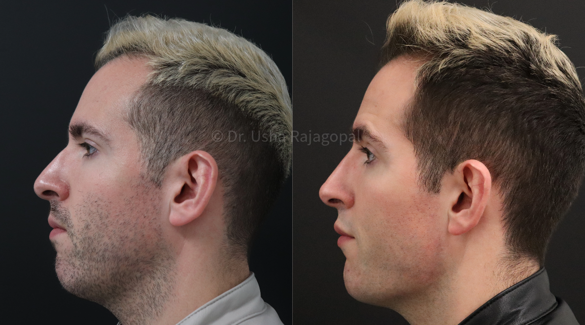 full face rejuvenation_3.png