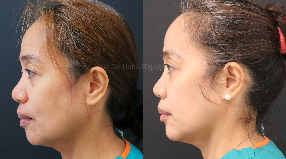 full face rejuvenation_6.png