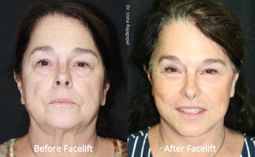 facelift_beforeafter_1.jpeg