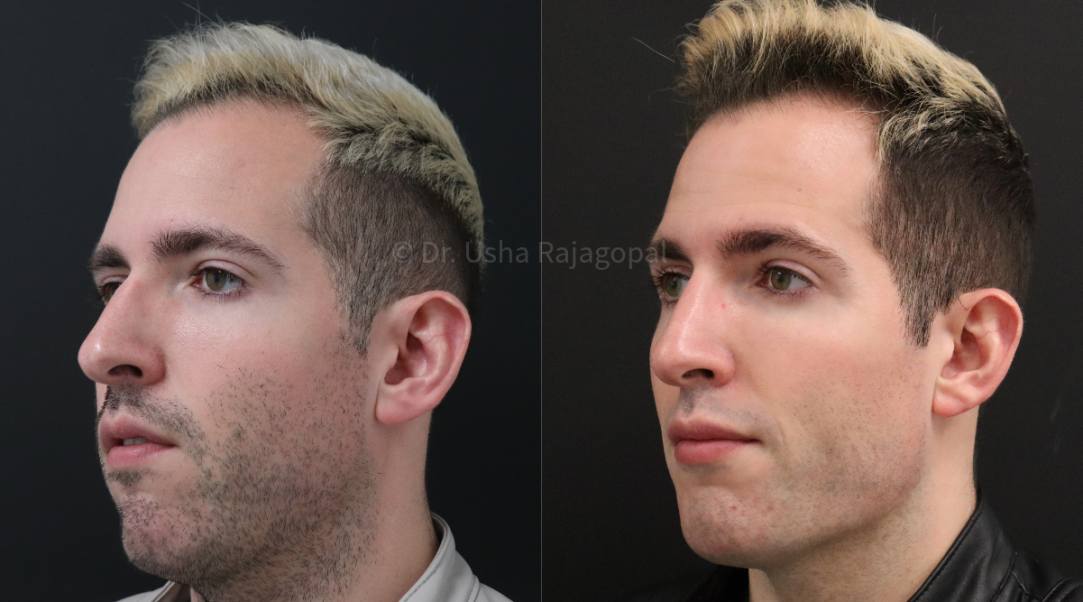 full face rejuvenation_2.png