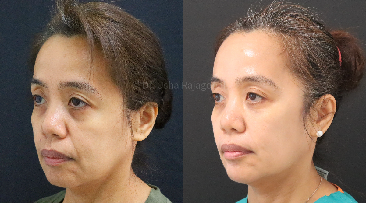full face rejuvenation_5.png