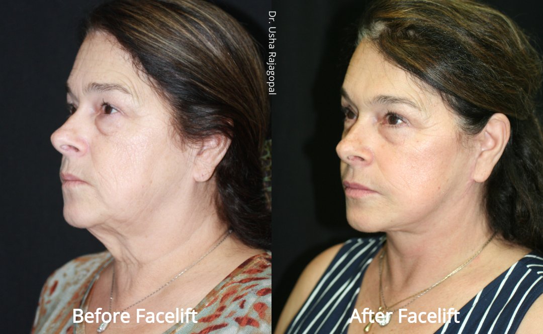 facelift_beforeafter_3.jpeg