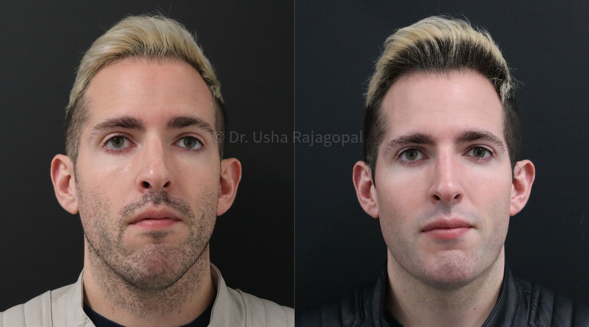 full face rejuvenation_1.png