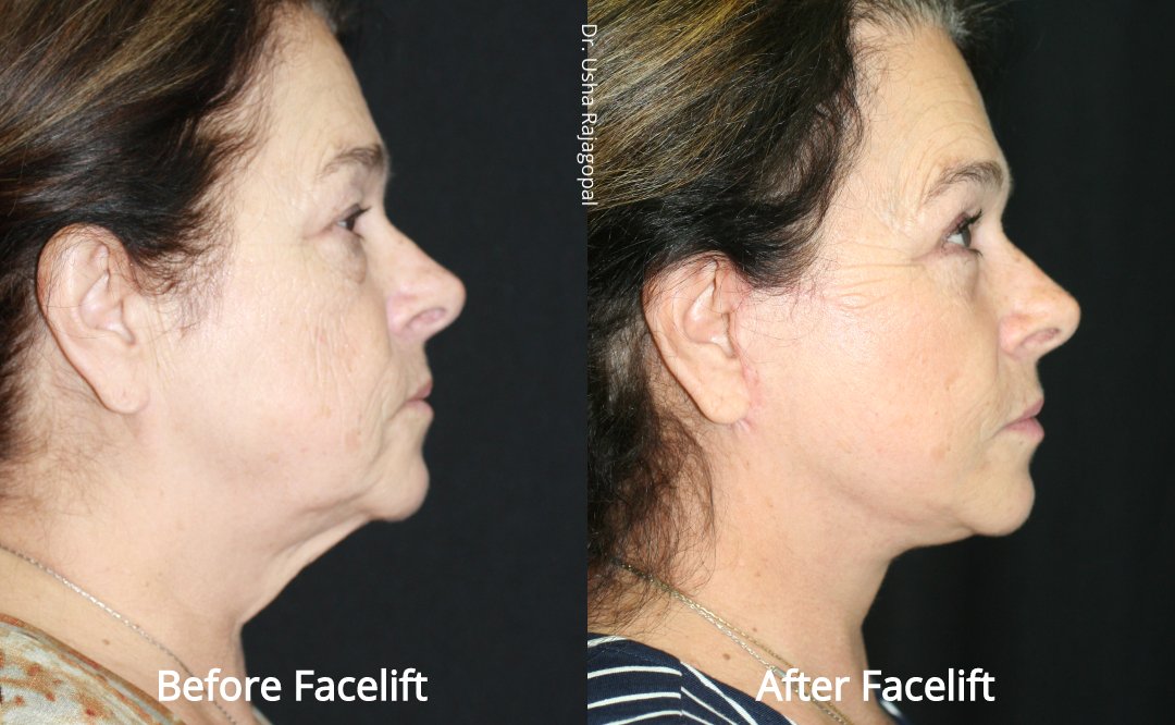 facelift_beforeafter_2.jpeg
