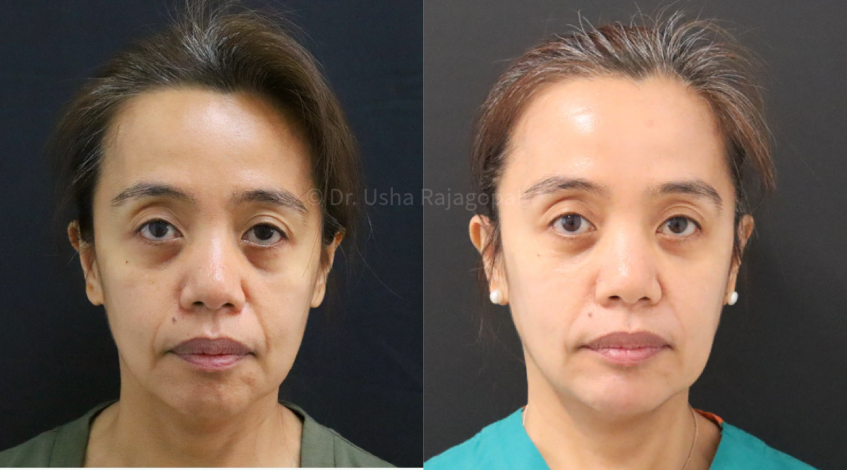 full face rejuvenation_4.png