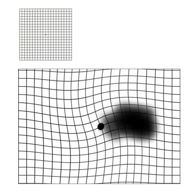An Amsler grid showing mild distortion.