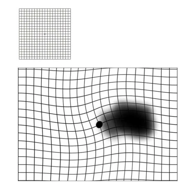 The Amsler grid (top image) can help detect early signs of retinal disease and monitor changes in vision. The image on the bottom shows an example of distortion and blurring of vision.