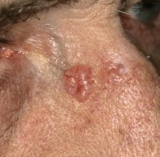 Nodular BCC