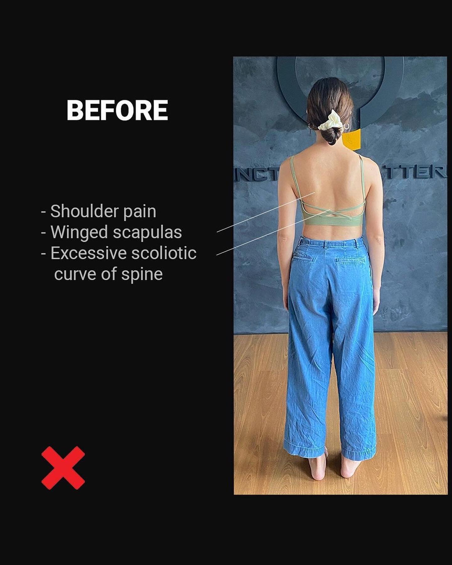 Posted @withregram • @functionalpatterns Making scoliosis gains without all the pains. Great work here by @chunyi_hsiao out of @fp.taiwan .
If you want to make relevant gains without the need for extreme discipline, get on the FP gain train. 
❇