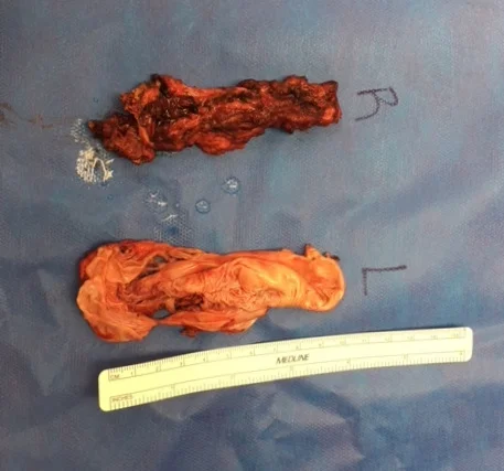Apparently, one side bled significantly more than the other, hence the color difference. These capsules adhere to your rib cage, and the surgeon has to scrape them off. A gory process.