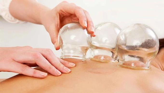 Orthocore PT in Rhode Island features cupping for lessening the pain of injuries and increasing blood flow to injured areas.